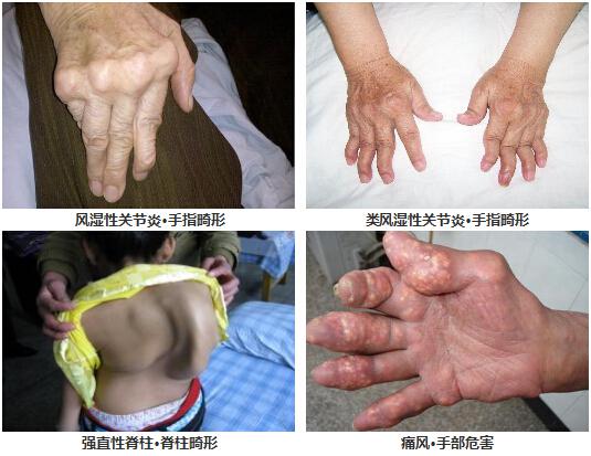 痛风风湿病症图